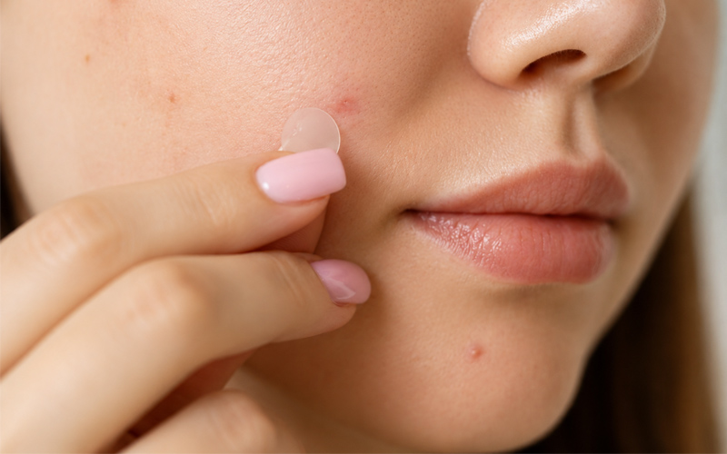 Acne and pimple treatment in Nellore